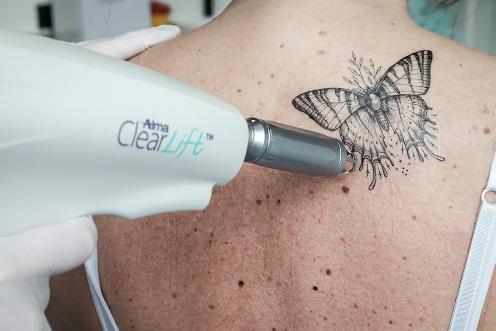 Laserbehandeling Tattoo verwijderen